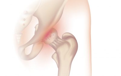 Trocanteritis: Qué es, Síntomas, Causas y Tratamiento sin Cirugía