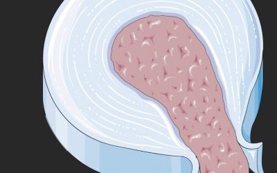 Hernia Discal: Qué es, Síntomas y Rehabilitación