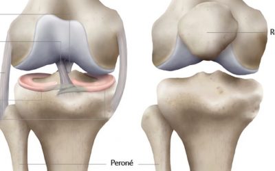 Rotura de Menisco: Recuperación en Lesiones de Menisco