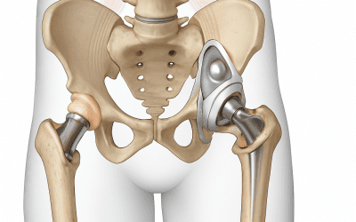Recuperación de una Operación de Labrum de Cadera